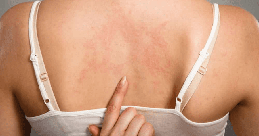 What Does Hepatitis C Rash Look Like:Early Detection, Better Treatment